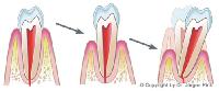 Parodontose: Eine tückische Bakterieninfektion des Zahnfleisches