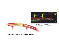 Koronare Herzerkrankung: Vor der Stent-Implantation kommt die Druckdrahtmessung