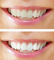 Zahnästhetik: Mit gesunden und schönen Zähnen in den Frühling!