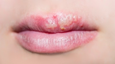 Herpes ein Virus mit vielen Gesichtern