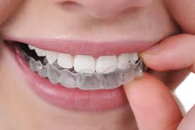 Schönere Zähne durch unsichtbare Zahnspange